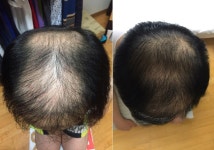 [탈모샴푸&토닉] 진짜 마지막으로 자올 시너지부스터 랑 스케일링 샴푸 쓰고있습니다 | 대한민국 1등 탈모 커뮤니티 대다모