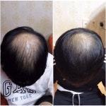 [병원치료] 안산 행복한여성의원행복한탈모전문클리닉 2번째 후기 | 대한민국 1등 탈모 커뮤니티 대다모