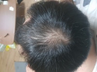 [복합처방] 울산 남**다모의원 조합약 5개월후기입니다. | 모발이식 후기, 리뷰, 비용은 대다모!