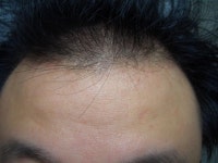 이마라인을 축소를 하는게 나을까요 아니면 그 모낭으로 좀더 많은 부위에 밀도를 | 대한민국 1등 탈모 커뮤니티 대다모