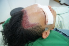 [모발이식] 몇일전 수술을했습니다 4000모 1600모낭했는데 평가좀해주십쇼 | 대한민국 1등 탈모 커뮤니티 대다모