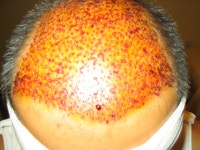 잘다녀왔습니다언빈입니다 | 대한민국 1등 탈모 커뮤니티 대다모