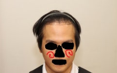 [모발이식] 디자인 어떤가요 | 대한민국 1등 탈모 커뮤니티 대다모