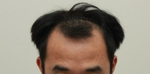 [Review] 닥터 안 헤어플란트 절개식 모발이식 3800모 후기입니다 | Koreas No.1 Hair Loss Community, DAEDAMO