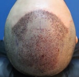 [국내] 포토후기1 -닥터 모라인(수술 전 /수술 직 후 /수술 후 1일 차) 국내 포토후기1 닥터 모라인수술 전 수술 직 후 수술 후 1일 차