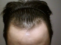 모발이식생각중인데요사진보구답변좀 | 대한민국 1등 탈모 커뮤니티 대다모