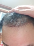 이식 33일차 입니다 이식33일차입니다