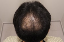 [인천 마이모 모발이식의원] 마이모에서 정수리 모발이식받고 한달차 기록 | 모발이식 후기, 리뷰, 비용은 대다모!