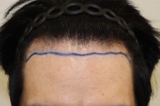 [대구 헤어로의원] 이마라인 낮추니 원래 풍성했던 사람이 되버린.. 마지막후기 | 모발이식 후기, 리뷰, 비용은 대다모!