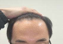 [모든모의원] 모든모의원 비절개 모발이식 후기 | 모발이식 후기, 리뷰, 비용은 대다모!