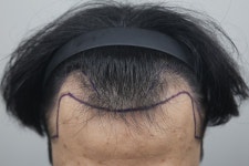 [모나라피부과의원] 엠자 4000모 8개월 아주 굿입니다요~ | 모발이식 후기, 리뷰, 비용은 대다모!