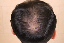 [움찬의원] 움찬의원 비절개 2000모 후기 | 모발이식 후기, 리뷰, 비용은 대다모!