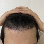 [인천 마이모 모발이식의원] 인천 마이모의원 1038모낭 비절개 2주 경과 후기 | 모발이식 후기, 리뷰, 비용은 대다모!