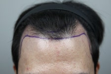 [모나라피부과의원] 모발이식 12개월차 아주 만족합니다^^ | 모발이식 후기, 리뷰, 비용은 대다모!