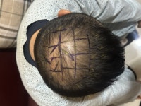 [뉴헤어모발성형외과의원] 뉴헤어성형외과 모발이식 7일차 | 모발이식 후기, 리뷰, 비용은 대다모!