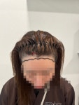 [모우다의원] 모우다 의원 헤어라인 이식 솔직후기 | 모발이식 후기, 리뷰, 비용은 대다모!