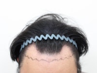 [모프로의원] 신사역 모프로의원 문건학 원장님 엠자 모발이식 6개월차 후기 | 모발이식 후기, 리뷰, 비용은 대다모!