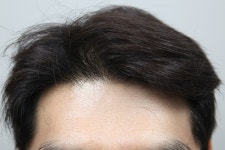 [MONARA dermatology clinic] 정수리 + 헤어라인 모발이식 5000모 8개월차 후기! | Hair transplant reviews, stories, and costs... 