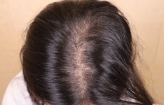 [Domestic Surgery Reviews] 움찬의원 비절개 800모 모발이식 1달차 후기 | Hair transplant reviews, stories, and costs — all on... 
