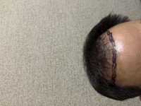 [뉴헤어모발성형외과의원] 강남모발이식병원 뉴헤어 7일차 비절개 모발이식 후기 입니다~ 2500모낭 했어요~ | 모발이식 후기, 리뷰, 비용은 대다모!
