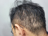 [국내수술후기] [강남 미켈란의원] 체모이식과 색소치료를 받으며 느낀 후기 | 모발이식 후기, 리뷰, 비용은 대다모!