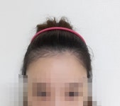 여자 헤어라인 견적좀 부탁드려요 여성헤어라인 여자 헤어라인 견적좀 부탁드려요