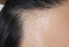 [이마라인] K36434977182407301240 님의 Hair bnb 여행지 | 대한민국 1등 탈모 커뮤니티 대다모