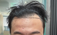 [이마라인] 고00 님의 Hair bnb 여행지 | 대한민국 1등 탈모 커뮤니티 대다모