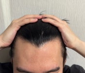 XQ Hair(엑스큐 헤어) | [정수리 탈모] 엑스펙타 님의 Hair bnb 여행지 | 대한민국 1등 탈모 커뮤니티 대다모