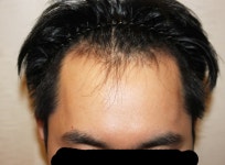 [남성탈모] 비절개 모발이식 (1400모낭) 1년째 진행중 경과 후기 봐주실분 | 모발이식 후기, 리뷰, 비용은 대다모!