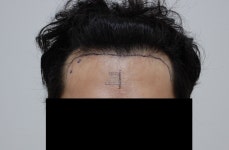[모바른의원] 2500모 M자 비절개 100일차 평가부탁드려요 | 모발이식 후기, 리뷰, 비용은 대다모!