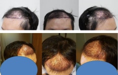 [뉴헤어모발성형외과의원] 2005모낭 3일차 수술 전후 사진 입니다. | 모발이식 후기, 리뷰, 비용은 대다모!