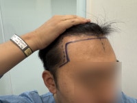 [모원성형외과의원] 헤어라인 무삭발 비절개모발이식 1400모낭 1년!! 모원성형외과 | 모발이식 후기, 리뷰, 비용은 대다모!