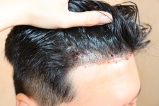 [WOOMCHAN Hair Transplant Clinic] 움찬의원 비절개 수술후기 | Hair transplant reviews, stories, and costs — all on DAEDAMO!