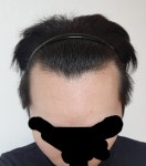 [남성탈모] 모플러스성형외과 비절개 2100모 3일째입니다 | 모발이식 후기, 리뷰, 비용은 대다모!