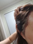 [뉴헤어모발성형외과의원] 6개월차 후기 | 모발이식 후기, 리뷰, 비용은 대다모!