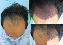 [한나이브모발이식센터] 2016년 3월26일 수술했습니다. 1차 후기 3개월 6개월 9개월 12개월 천천히 올려볼게요~ | 모발이식 후기, 리뷰... 