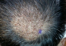 [모재성모발이식센터] 모재성 성형외과 12/21일에 정수리탈모 비절개 이식했습니다. | 모발이식 후기, 리뷰, 비용은 대다모!