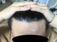 [뉴헤어모발성형외과의원] 드디어 저도 1년후기 올립니다. | 모발이식 후기, 리뷰, 비용은 대다모!