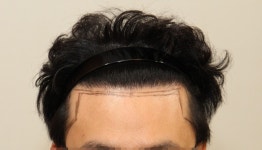 [뉴헤어모발성형외과의원] 재수술후 1년이지났습니다 | 모발이식 후기, 리뷰, 비용은 대다모!