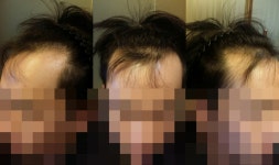 [뉴헤어모발성형외과의원] 1360모낭 슬릿 수술 받은지 10일이에요 | 모발이식 후기, 리뷰, 비용은 대다모!