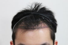 [뉴헤어모발성형외과의원] 슬릿 1500모낭 1년동안 경과 후기. | 모발이식 후기, 리뷰, 비용은 대다모!