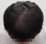 [뉴헤어모발성형외과의원] 정수리에 4000모 후기입니다. | 모발이식 후기, 리뷰, 비용은 대다모! [뉴헤어모발성형외과의원] 정수리에 4000모... 