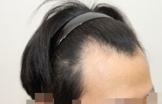 [뉴헤어모발성형외과의원] 3000모 수술 후 6개월 계속 관리 중... | 모발이식 후기, 리뷰, 비용은 대다모! [뉴헤어모발성형외과의원] 3000모 수술... 