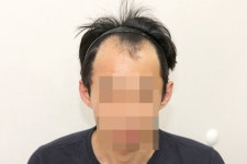 [뉴헤어모발성형외과의원] 뉴헤어에서 수술한지 9개월 됐습니다 | 모발이식 후기, 리뷰, 비용은 대다모!