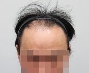 [뉴헤어모발성형외과의원] 한번의 실패후.. 재수술 | 모발이식 후기, 리뷰, 비용은 대다모!