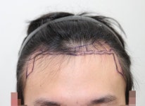 [뉴헤어모발성형외과의원] 모발이식 1500모낭 6개월째 입니다! | 모발이식 후기, 리뷰, 비용은 대다모!