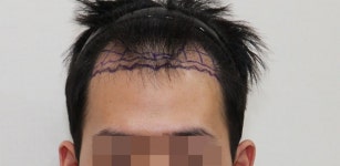 [뉴헤어모발성형외과의원] 1300모낭수술 후 엠자이마 탈출이네요 | 모발이식 후기, 리뷰, 비용은 대다모!