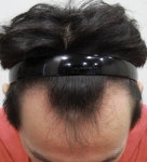 [뉴헤어모발성형외과의원] 크리스마스 선물같은 모발이식 후!! 비절개로 1500모낭심었습니다 | 모발이식 후기, 리뷰, 비용은 대다모!