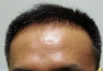 중국 북경 5천모낭 6개월 20일차 포토후기 입니다. | 모발이식 후기,리뷰,비용은 대다모!